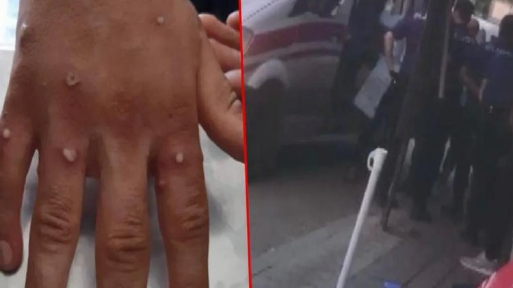 İstanbul’da maymun çiçeği alarmı! Ellerinde yaralar çıkan 3 kişi ekipler tarafından alındı, test sonuçları bekleniyor